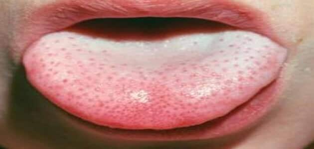 ما هو علاج فطريات الفم واللسان