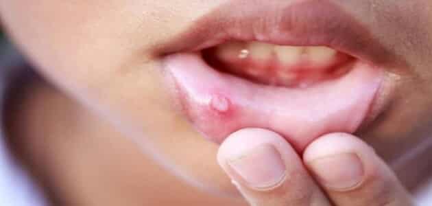 ما هي أنواع قرحة الفم واللسان