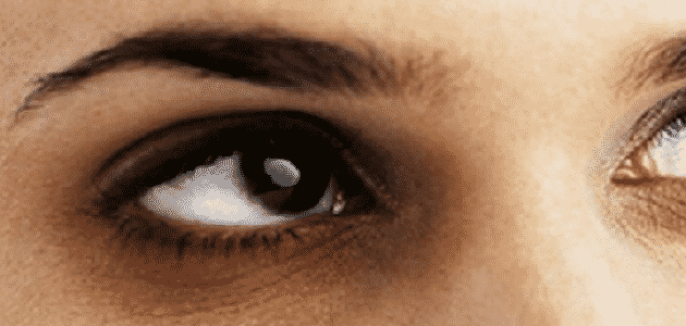 الهالات السوداء تحت العين وعلاجها | مقال