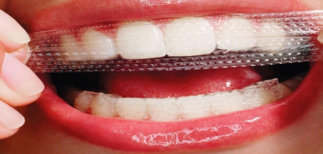 أضرار أنواع لصقات تبييض الأسنان