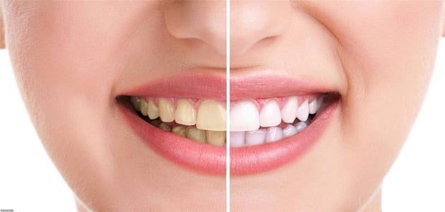 تغيّر لون الأسنان: الأسباب والعلاج الطبيعي