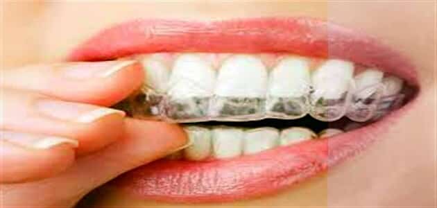 طرق تجميل الاسنان بدون تقويم