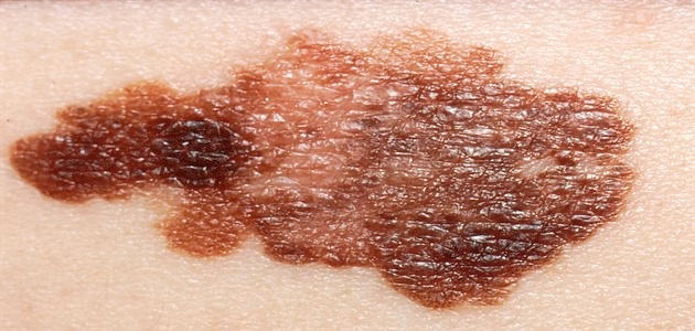 كيفية علاج نقص صبغة الجلد