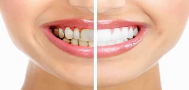 انواع تبييض الاسنان واسعارها في مصر - مقال