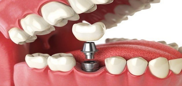 عملية زراعة الأسنان | الفوائد والأضرار والتكلفة