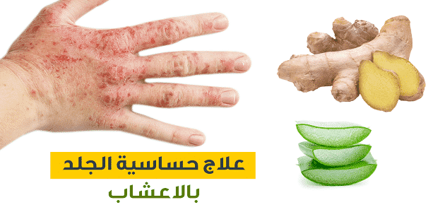 علاج حساسية الجلد والهرش بالاعشاب