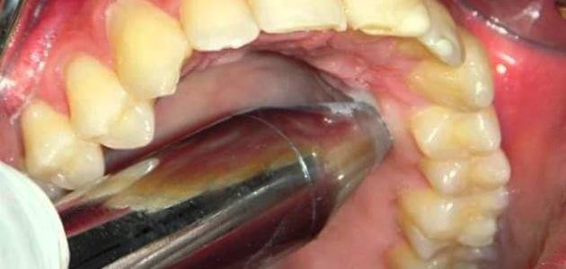 علاج الخراج الأسنان