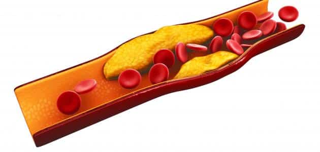 اسباب ارتفاع الكوليسترول في الدم