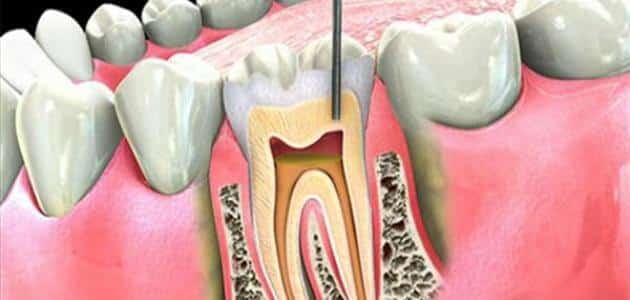 
عصب الاسنان الملتهب 