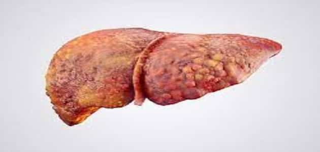 هل مرض تليف الكبد معدي ام لا؟
