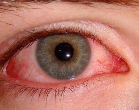 اسباب دموع العين بدون سبب وطرق علاجه | مقال