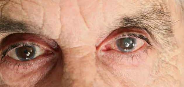 أمراض العيون وعلاجها | مقال