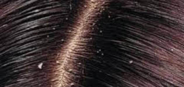 أخطر أنواع قشرة الشعر
