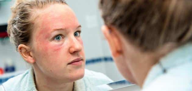 أنواع أكزيما الوجه وعلاجها