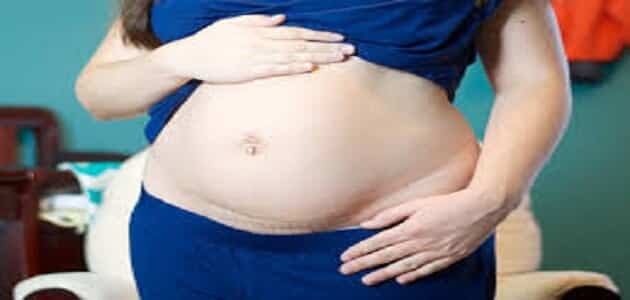 اعراض فتق السرة عند الحامل وعلاجه