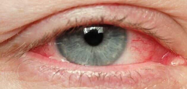 أمراض العيون وعلاجها | مقال