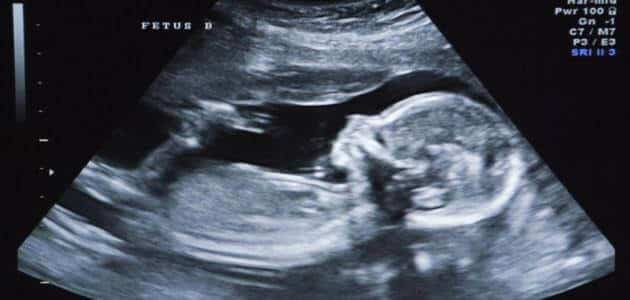 تفسير حلم إجهاض الجنين للعزباء