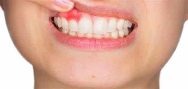 خراج الأسنان بالثوم والملح