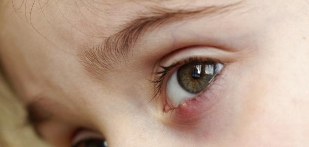 قطرة مضاد حيوي للعين للأطفال