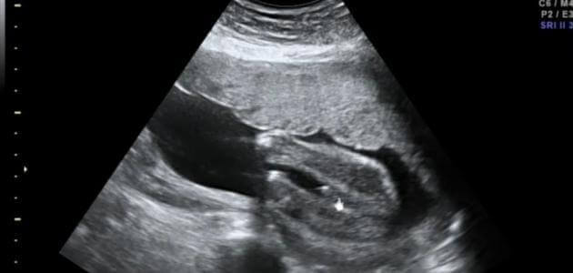 شكل الجنين في الشهر الثالث الذكر