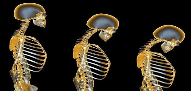 علاج هشاشة العظام عند كبار السن بالاعشاب
