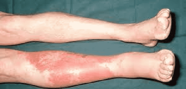 أسباب التهاب النسيج الخلوي في الساق