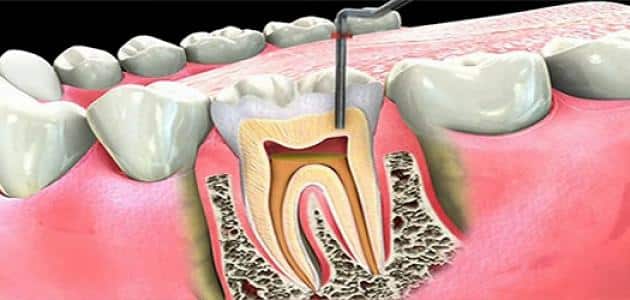 الاسنان افضل علاج لالم علاجات منزلية