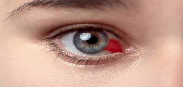 حمراء اطفال عيون تأثير العين