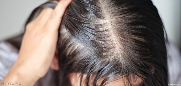 علاج الشعر الخفيف وراثيا