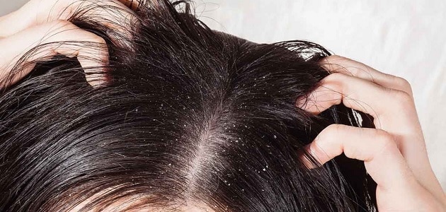 علاج القشرة في الشعر من أول مرة