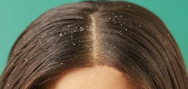 علاج قشرة الشعر الدهني