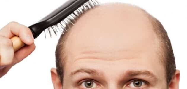 طرق طبيعية لإنبات الشعر في أماكن الصلع