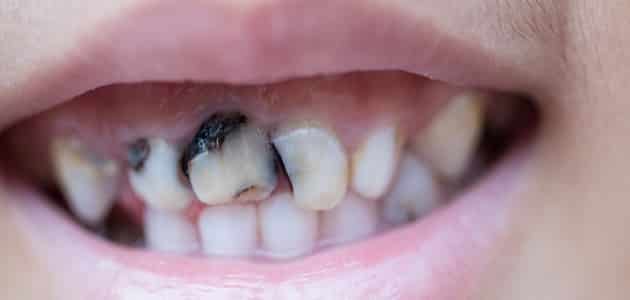 أسباب تآكل الأسنان من الجذور