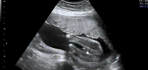 هل يخطئ السونار في تحديد نوع الجنين في الشهر الخامس