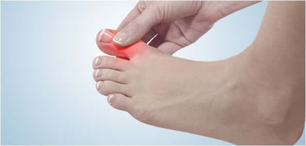 علاج تورم إصبع القدم الكبير