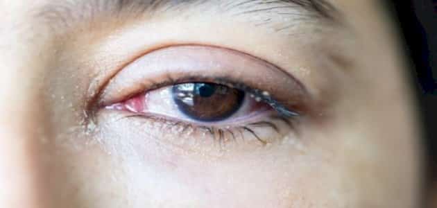 ماذا يعني نزول الدموع من العين اليسرى