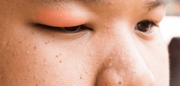 علاج انتفاخ الوجه بسبب الكورتيزون