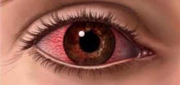أسباب احمرار العين عند الاستيقاظ