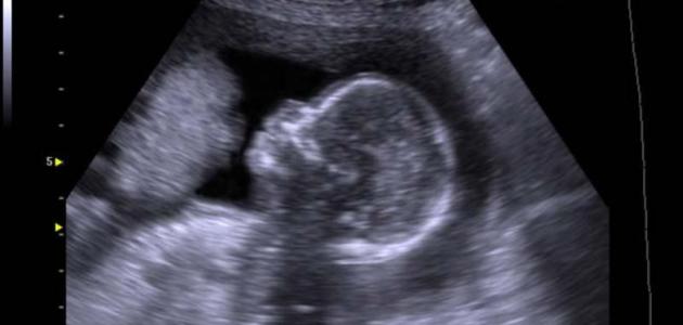 هل السونار المهبلي يكشف الحمل قبل الدورة
