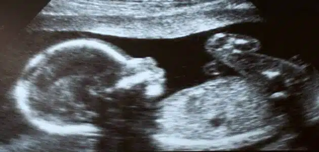 تشابه الأعضاء التناسلية للجنين في الشهر الخامس