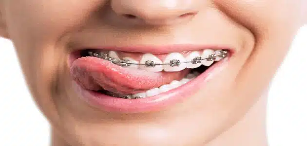 تفسير تصليح الأسنان في المنام للعزباء